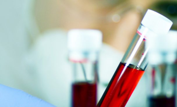 Non-Hodgkin’s lymphoma