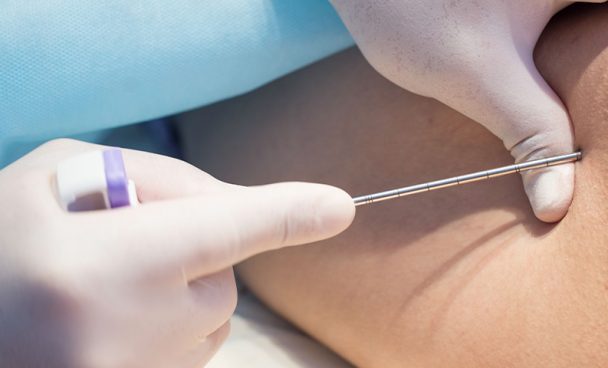 Mielograma – Biopsia de Medula Óssea