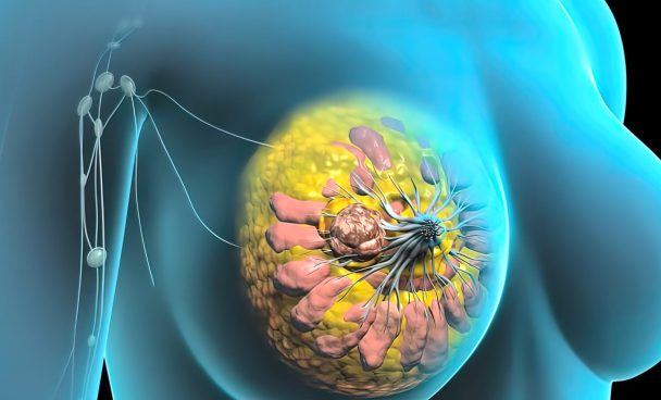 Câncer de mama RH+, câncer de pâncreas com ATM mut germinativo e MSI em câncer de pulmão